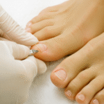 ingrown toenail doctor
